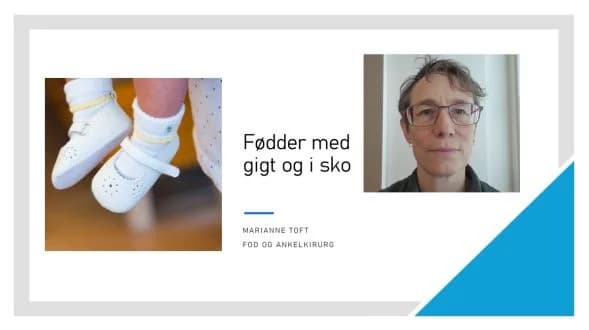 Fødder med gigt og i sko ved fodkirurg Marianne Toft